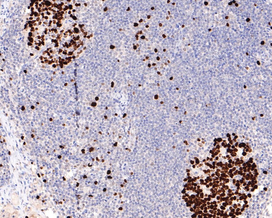 Immunohistochemical analysis of paraffin-embedded human lymph nodes tissue with Rabbit anti-Ki67 antibody (<a href="/products/HA721115" style="font-weight: bold;text-decoration: underline;">HA721115</a>) at 1/15,000 dilution.<br /><br />The section was pre-treated using heat mediated antigen retrieval with sodium citrate buffer (pH 6.0) for 2 minutes. The tissues were blocked in 1% BSA for 20 minutes at room temperature, washed with ddH<sub>2</sub>O and PBS, and then probed with the primary antibody (<a href="/products/HA721115" style="font-weight: bold;text-decoration: underline;">HA721115</a>) at 1/15,000 dilution for 1 hour at room temperature. The detection was performed using an HRP conjugated compact polymer system. DAB was used as the chromogen. Tissues were counterstained with hematoxylin and mounted with DPX.