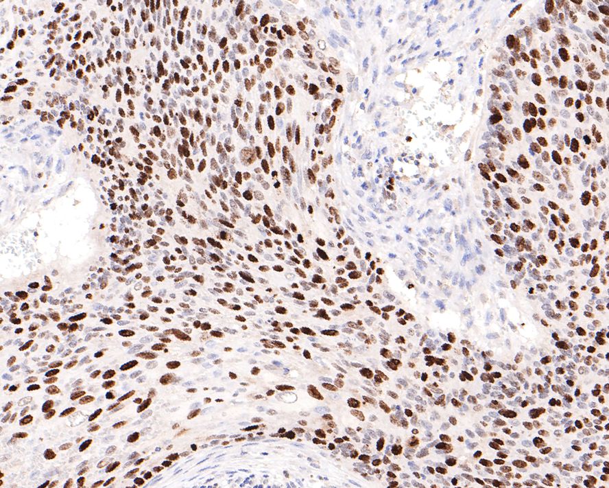 Immunohistochemical analysis of paraffin-embedded human cervical carcinoma tissue with Rabbit anti-Ki67 antibody (<a href="/products/HA721115" style="font-weight: bold;text-decoration: underline;">HA721115</a>) at 1/15,000 dilution.<br /><br />The section was pre-treated using heat mediated antigen retrieval with sodium citrate buffer (pH 6.0) for 2 minutes. The tissues were blocked in 1% BSA for 20 minutes at room temperature, washed with ddH<sub>2</sub>O and PBS, and then probed with the primary antibody (<a href="/products/HA721115" style="font-weight: bold;text-decoration: underline;">HA721115</a>) at 1/15,000 dilution for 1 hour at room temperature. The detection was performed using an HRP conjugated compact polymer system. DAB was used as the chromogen. Tissues were counterstained with hematoxylin and mounted with DPX.
