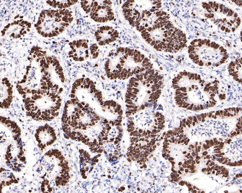 Immunohistochemical analysis of paraffin-embedded human colon carcinoma tissue with Rabbit anti-Ki67 antibody (<a href="/products/HA721115" style="font-weight: bold;text-decoration: underline;">HA721115</a>) at 1/15,000 dilution.<br /><br />The section was pre-treated using heat mediated antigen retrieval with sodium citrate buffer (pH 6.0) for 2 minutes. The tissues were blocked in 1% BSA for 20 minutes at room temperature, washed with ddH<sub>2</sub>O and PBS, and then probed with the primary antibody (<a href="/products/HA721115" style="font-weight: bold;text-decoration: underline;">HA721115</a>) at 1/15,000 dilution for 1 hour at room temperature. The detection was performed using an HRP conjugated compact polymer system. DAB was used as the chromogen. Tissues were counterstained with hematoxylin and mounted with DPX.