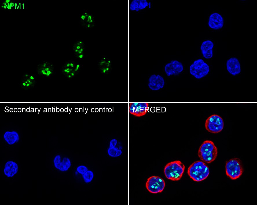 Immunohistochemical analysis of paraffin-embedded human colon carcinoma tissue with Rabbit anti-Nucleophosmin antibody (<a href=