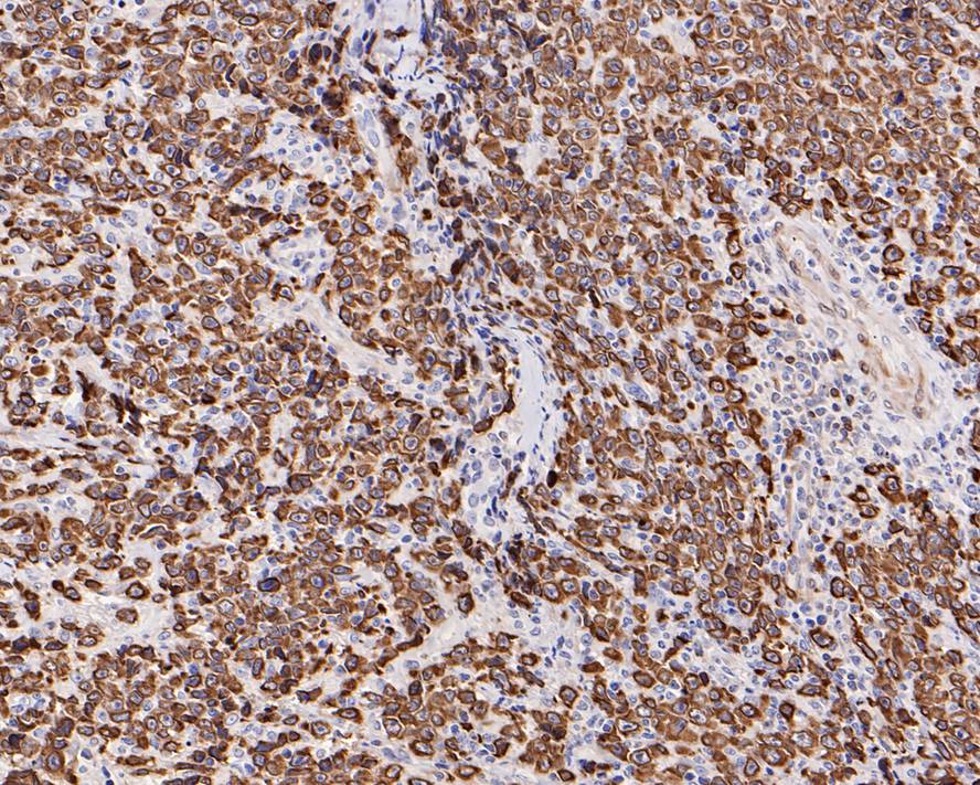 Immunohistochemical analysis of paraffin-embedded human B-cell lymphoma tissue with Rabbit anti-Bcl-2 antibody (<a href="/products/HA721235" style="font-weight: bold;text-decoration: underline;">HA721235</a>) at 1/1,000 dilution.<br /><br />The section was pre-treated using heat mediated antigen retrieval with Tris-EDTA buffer (pH 9.0) for 20 minutes. The tissues were blocked in 1% BSA for 20 minutes at room temperature, washed with ddH<sub>2</sub>O and PBS, and then probed with the primary antibody (<a href="/products/HA721235" style="font-weight: bold;text-decoration: underline;">HA721235</a>) at 1/1,000 dilution for 1 hour at room temperature. The detection was performed using an HRP conjugated compact polymer system. DAB was used as the chromogen. Tissues were counterstained with hematoxylin and mounted with DPX.