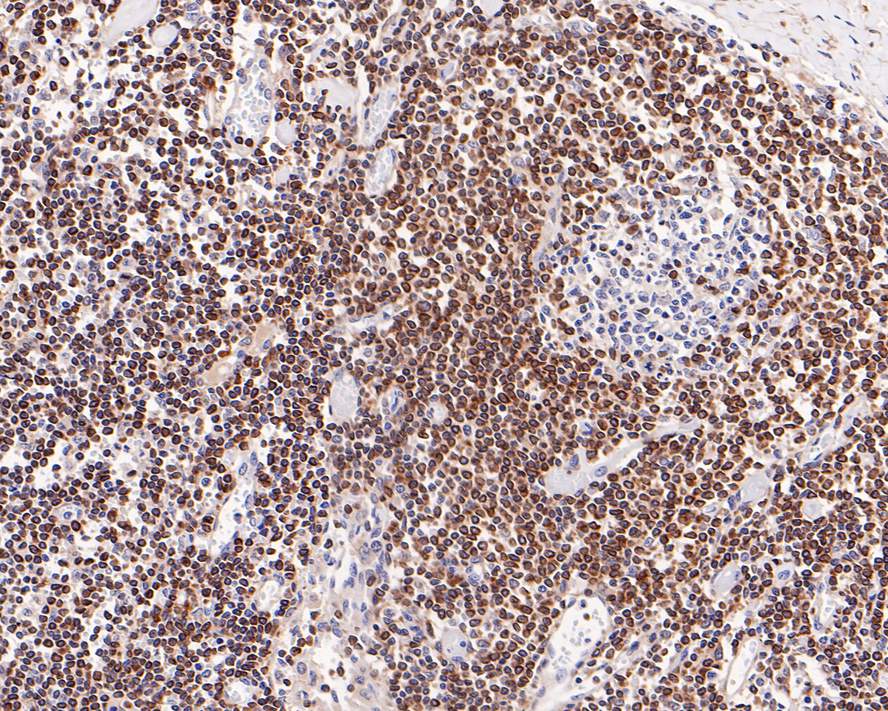 Immunohistochemical analysis of paraffin-embedded human lymph nodes tissue with Rabbit anti-Bcl-2 antibody (<a href="/products/HA721235" style="font-weight: bold;text-decoration: underline;">HA721235</a>) at 1/5,000 dilution.<br /><br />The section was pre-treated using heat mediated antigen retrieval with Tris-EDTA buffer (pH 9.0) for 20 minutes. The tissues were blocked in 1% BSA for 20 minutes at room temperature, washed with ddH<sub>2</sub>O and PBS, and then probed with the primary antibody (<a href="/products/HA721235" style="font-weight: bold;text-decoration: underline;">HA721235</a>) at 1/5,000 dilution for 1 hour at room temperature. The detection was performed using an HRP conjugated compact polymer system. DAB was used as the chromogen. Tissues were counterstained with hematoxylin and mounted with DPX.